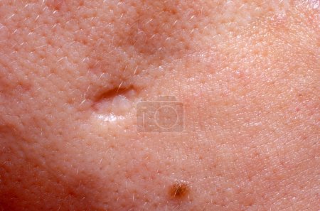 Photo for Scar after big pimple on human skin - Royalty Free Image