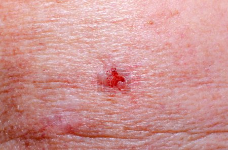 Photo for Nevus or basaliomaon the skin of an adult close-up - Royalty Free Image