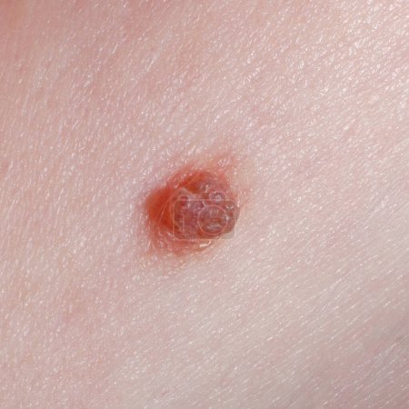 Photo for Nevus or mole on the skin of the human body close-up. - Royalty Free Image