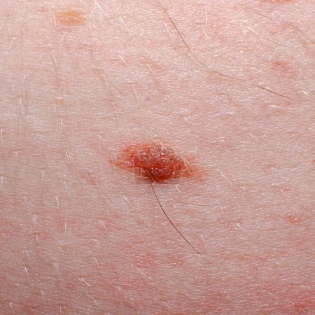 Photo for Nevus or mole on the human body close-up. Skin cancer, keratosis or melanoma on the skin. - Royalty Free Image