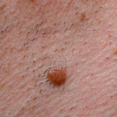 Nevus or mole on the skin of the human body close-up.