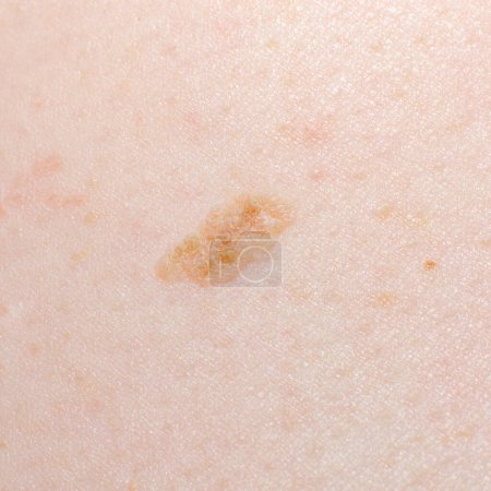 Photo for Nevus or mole on the human body close-up. Skin cancer, keratosis or melanoma on the skin. - Royalty Free Image
