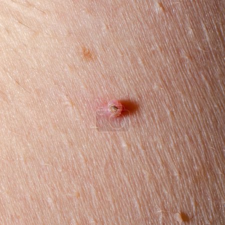 Photo for A wound on a nevus on a human skin close-up. Damaged mole. - Royalty Free Image