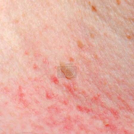 Photo for Keratosis or papilloma on the skin of an adult. Irritation or allergic reaction. - Royalty Free Image