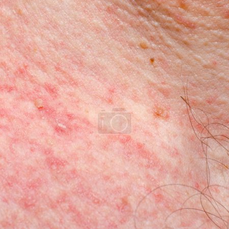 Photo for Keratosis or papilloma on the skin of an adult. Irritation or allergic reaction. - Royalty Free Image