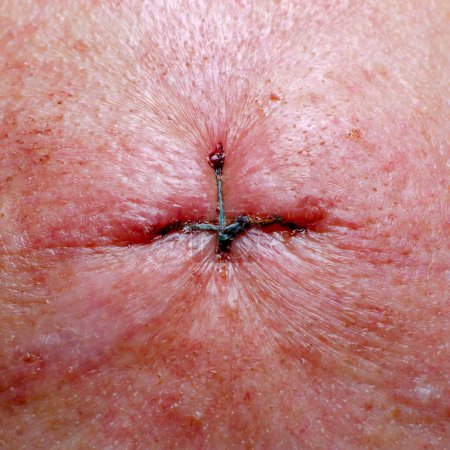 Photo for The wound was sutured with surgical threads. Surgical removal of basalioma on the skin of the face. - Royalty Free Image