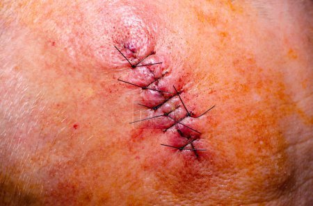 Photo for Wound after surgery protection with surgical thread close-up - Royalty Free Image
