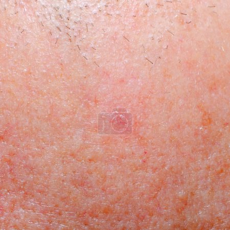 Photo for Basalioma or solar keratosis on the scalp of an adult - Royalty Free Image