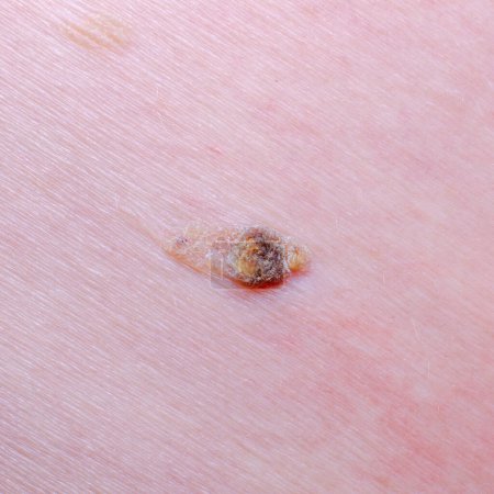 Nevus or mole on the skin of an adult