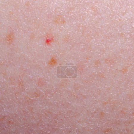 Photo for Nevus or mole on the skin of an adult - Royalty Free Image