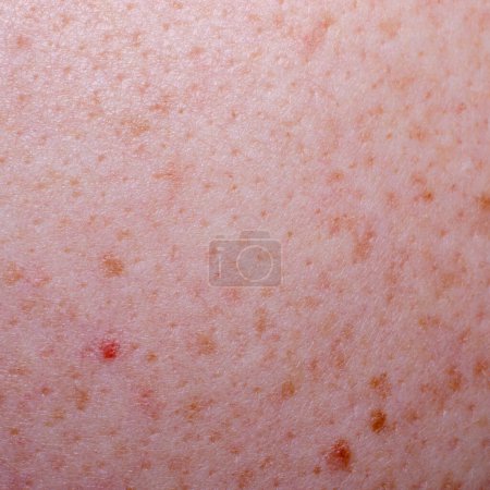 Photo for Nevus or mole on the skin of an adult - Royalty Free Image