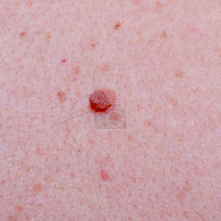Nevus or mole on the skin of an adult