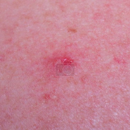 Photo for Wet basalioma on the skin of an adult - Royalty Free Image