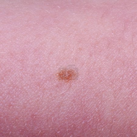 Photo for Mole or nevus on a child's skin - Royalty Free Image