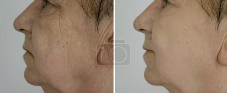Téléchargez les photos : Femme âgée visage rides avant et après le traitement - en image libre de droit