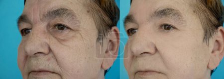 Falten im Gesicht der Frau vor und nach der Behandlung