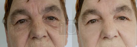 Photo for Woman face wrinkles before and after treatment - Royalty Free Image