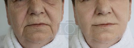 Falten im Gesicht der Frau vor und nach der Behandlung