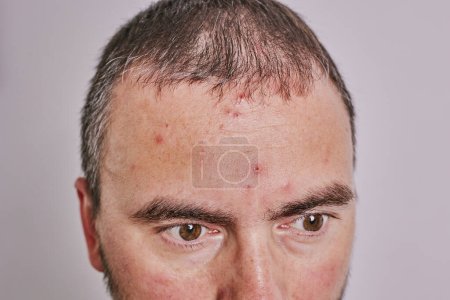 Männliche Stirn mit Akne, roten Flecken, Hauterkrankungen. Varizellen oder Herpes Zoster Konzept
