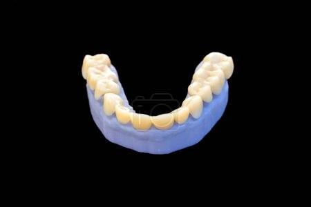Téléchargez les photos : Un modèle de dent imprimé par impression 3D placé sur un modèle dentaire bleu sur un fond noir - en image libre de droit