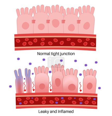 Ilustración de Síndrome del intestino goteante: unión apretada normal, goteo e inflamación. - Imagen libre de derechos