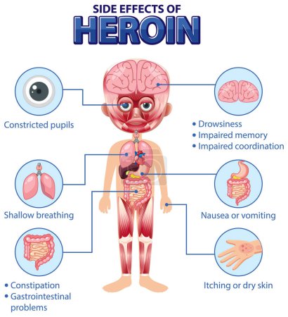 Téléchargez les illustrations : Anatomie humaine diagramme dessin animé style de l'héroïne effets secondaires illustration - en licence libre de droit
