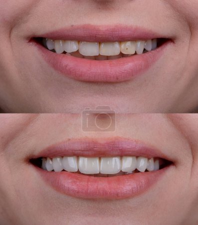 Téléchargez les photos : Avant et après le sourire relooking par placage en céramique dentaire, placages en porcelaine stratifié sur les dents supérieures avant. Nouveau sourire. - en image libre de droit